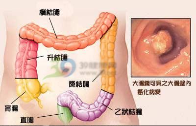 直肠瘤是怎么回事?直肠瘤能治好吗?