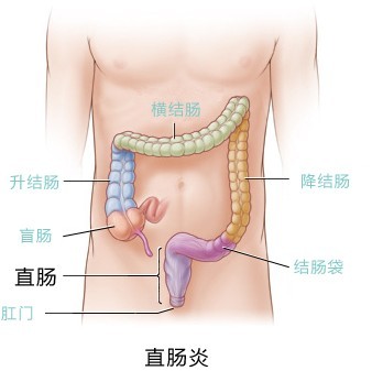 直肠炎是怎么回事？如何分辨是否患上了直肠炎？