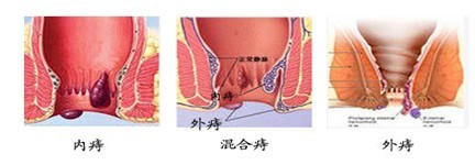 痔疮的医治方法哪种好?