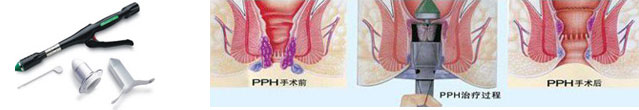 痔疮便血怎么回事？治疗痔疮便血那种方法好？