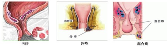 痔疮便血怎么回事？治疗痔疮便血那种方法好？